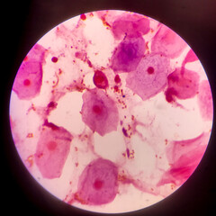 Bacteria cell Gram neagative bacilli with capsule.Sample sputum in Gram stain method.