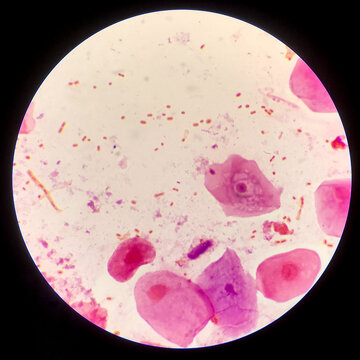 Bacteria cell Gram neagative bacilli with capsule.Sample sputum in Gram stain method.