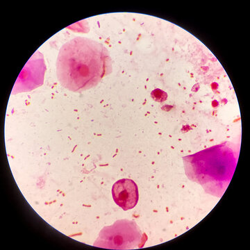 Bacteria cell Gram neagative bacilli with capsule.Sample sputum in Gram stain method.