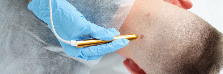 Doctor dermatologist laser cauterization of wart on man neck - obrazy, fototapety, plakaty