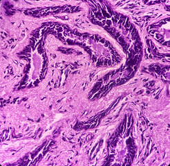 Hidradenoma papilliferum: Benign skin tumor, rare benign neoplasm, microscopic show cyst wall and...