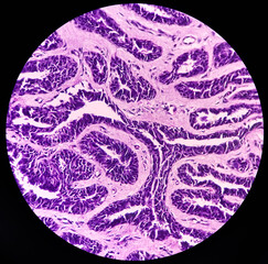 Hidradenoma papilliferum: Benign skin tumor, rare benign neoplasm, microscopic show cyst wall and...