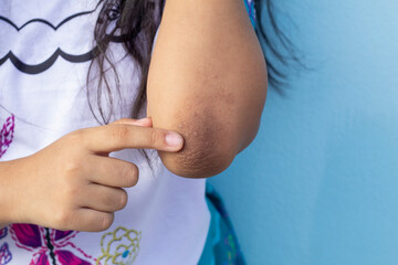 Finger of girl point to her elbow because dark patches on the skin and allergic rash known as...