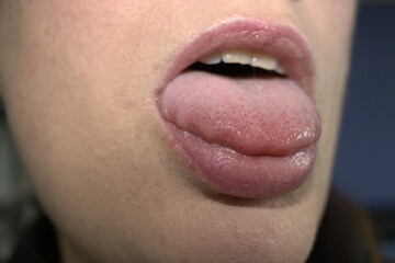 swollen enlarged white tongue with wavy ripple scalloped edges (medical name is macroglossia) and lie bumps