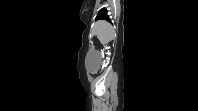 sagital abdomen ct scan image of Ovarian cystadenoma
