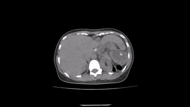 abdomen ct scan image of mesentero axial gastric volvulus 
