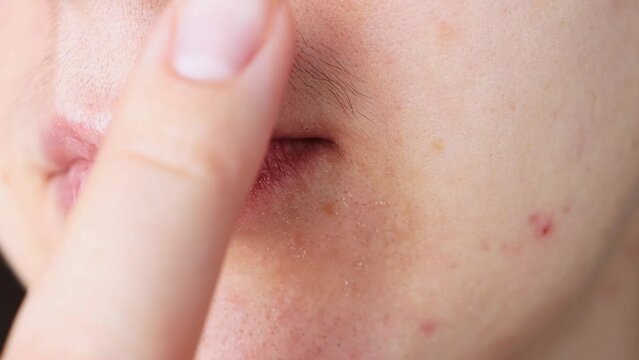 Woman's face with problematic skin and hair near the mouth. Disease, hirutism.