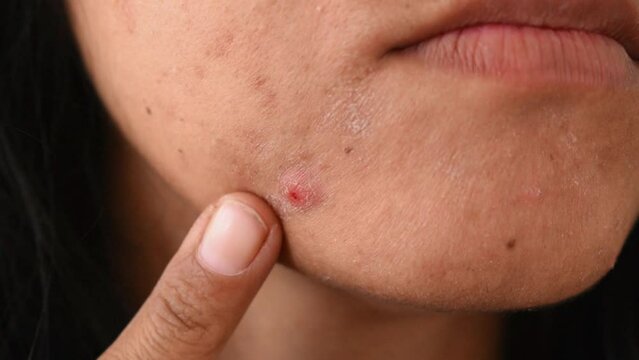 A Girl showing pimple on her face closeup