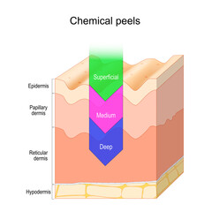 Chemical peel. Skin layers