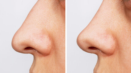 A profile of woman's nose before and after rhinoplasty. The result of cosmetic plastic surgery on...