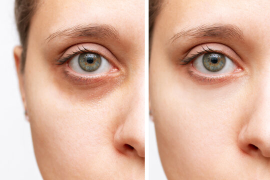Cropped shot of a young caucasian woman's face with dark circles under eye before and after cosmetic treatment isolated on a white background. Bruise under the eyes caused by fatigue, insomnia 