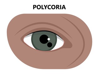 miosis eye pupil size iris retina brain Horner miotic muscle dilated ocular injury ptosis reflex Marcus Gunn defect optic nerve test palsy Trauma birth Adie tonic argyll hutchinson blind diplopia exam