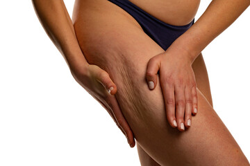 woman body care lifestyle concept of leg with wrinkled skin and cellulite