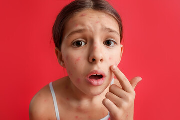 Little girl ill with chickenpox on red background