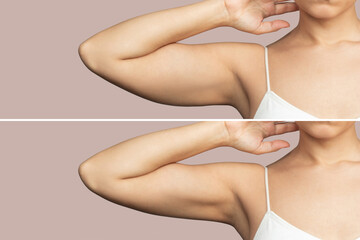 Cropped shot of young woman with excess fat on her upper arm before and after plastic surgery...