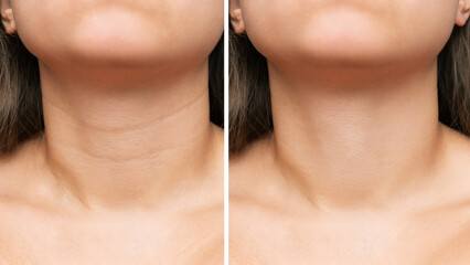 Сlose-up of young woman's neck with wrinkles before and after treatment. Result of cosmetic...