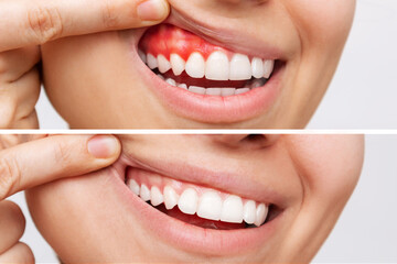 Two shots of a young woman with red bleeding gums and health gums, before and after treatment...