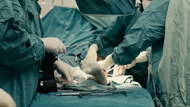 4k Slow motion, Assistant prepairing instruments support Orthopedic doctor perform in plate and screw internal fixation on leg surgery patient in operating room. Operation medical surgery procedure.
