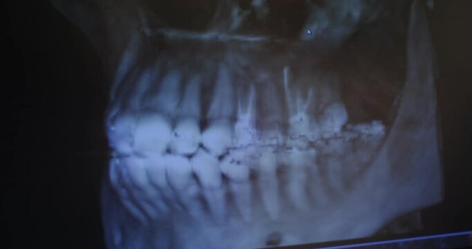 X-ray image of the patient's jaw on the doctor's monitor, close-up.