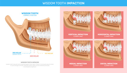 Wisdom Tooth Impaction Infographics - obrazy, fototapety, plakaty