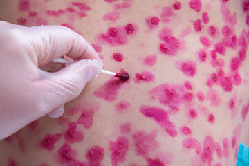 The skin rash in a child is treated with a cotton swab. Chickenpox virus. Skin rash and blisters on...