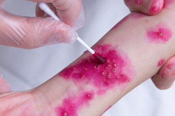 Fototapeta premium The skin rash in a child is treated with a cotton swab. Chickenpox virus. Skin rash and blisters on the body