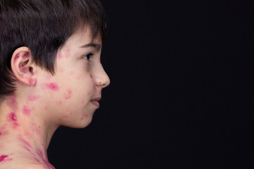 Close-up of cute little children. Chickenpox virus or vesicular rash on a child's body - obrazy, fototapety, plakaty