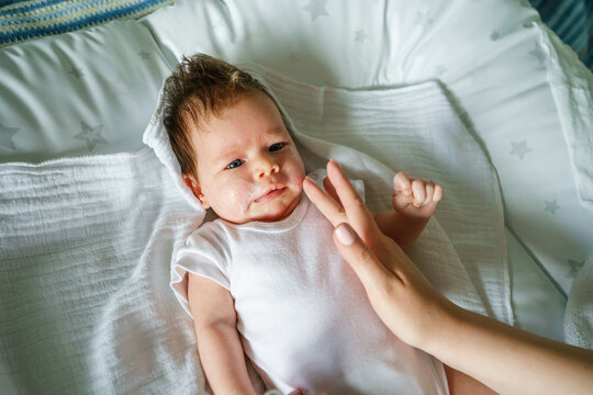 Neurodermatitis Chronic constitutional atopic eczema small newborn baby with dry skin problem on her face and hands of mother with medicine cream applying while lying on bed at home