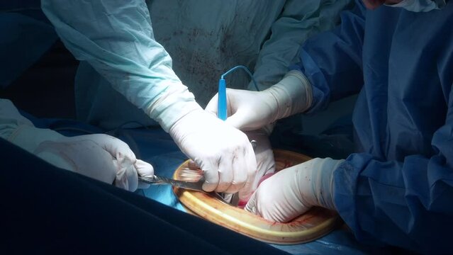 The hands of surgeons operate the patient with an electric coagulator. Close-up of hands in sterile gloves, stained with blood, during surgery.