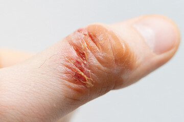 Chemical burn of a finger. Household burn. An open deep wound. Damaged epidermis. Regeneration process. Close up.