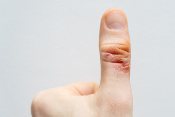 Chemical burn of a finger. Household burn. An open deep wound. Damaged epidermis. Regeneration...