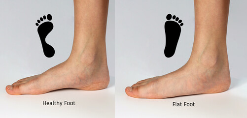 Normal neutral healthy foot compare with  flat foot or fallen arch problem with Foot print to show...