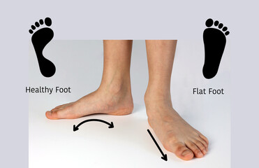 Normal neutral healthy foot compare with  flat foot or fallen arch problem with Foot print to show...