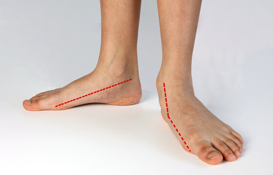 Compare normal healthy foot shape with flat foot fallen arch problem. The red line showing normal shape foot with abnormal shapes foot unstable medial column.