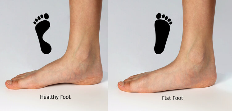 Normal neutral healthy foot compare with  flat foot or fallen arch problem with Foot print to show how entire sole of the foot to touch the floor when stand up.
