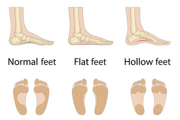 Foot deformity types, medical disease infographics. Hollow, flat, and normal foot. Vector Illustration - obrazy, fototapety, plakaty
