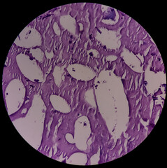Calcinosis cutis(subcutis): microscopic view show fibrocollagenous tissue and areas of...