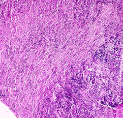 Carcinosarcoma of gallbladder(CSGB), show malignant neoplasm, atypical epithelial cells and spindle shaped cells, pleomorphism arranged in fascicles, perineural and lymphovascular invasion present.