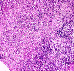 Carcinosarcoma of gallbladder(CSGB), show malignant neoplasm, atypical epithelial cells and spindle...
