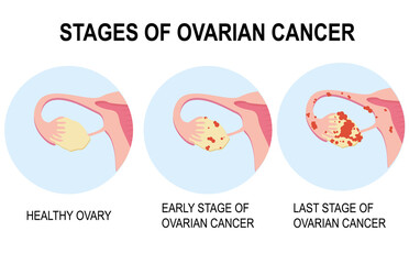 Diagram showing stages of ovarian cancer illustration. Pelvic cancer PCOS of the ovary. Ovarian cyst, polyp, pregnancy, fertility problems, female reproductive system, disease. Infographics, flat. - obrazy, fototapety, plakaty