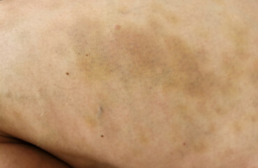 Bruises on the leg. Domestic violence problem. Close up on a bruise on the skin of an injured woman's leg