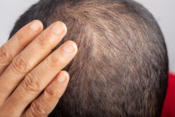 worried man showing visible hair loss scalp or thinning hair