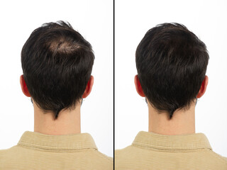 Nape of a young man with baldness principle before and after treatment
