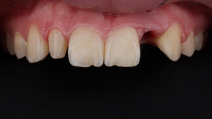 upper jaw with crown preparation and missing crown molar