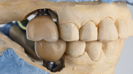 ceramic dental crowns from ceramics in the bite on models