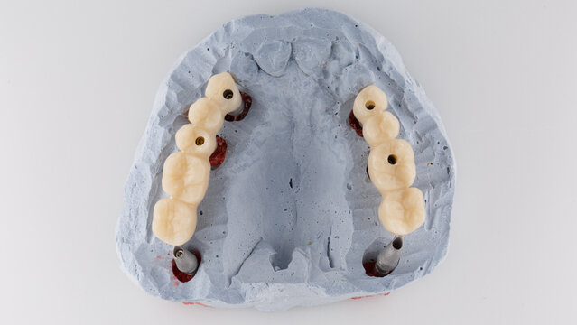 dental prostheses bridge for orthopedics in the masticatory area, top view on a white background