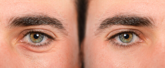 Eyes of man with and without eye bag before and after cosmetic treatment