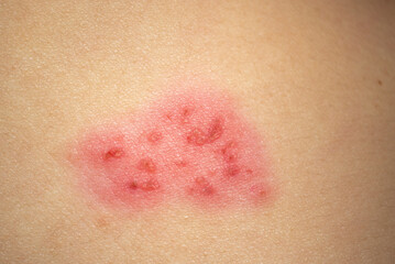 Fototapeta premium Herpes Zoster (shingles) on the skin, close up.
