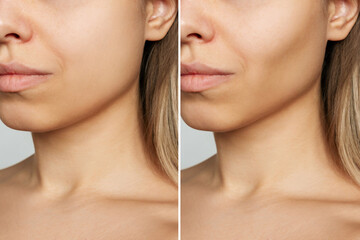Cropped shot of young woman's face before and after plastic surgery buccal fat pad removal. A lower part of face with clear highlighted cheekbones. Result of cosmetic surgery - obrazy, fototapety, plakaty