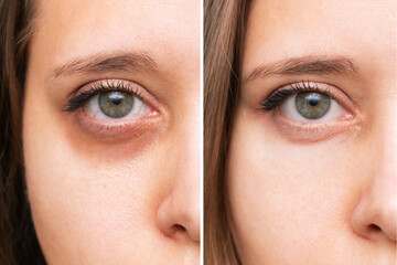 Cropped shot of a young caucasian woman's face with dark circles under eyes before and after cosmetic treatment. Bruises under the eyes caused by fatigue, insomnia. The result of therapy - obrazy, fototapety, plakaty